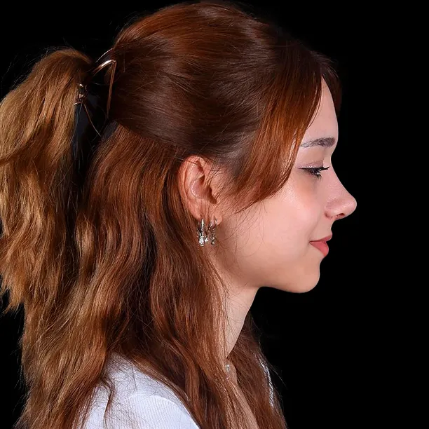 Resultado Rinoplastia - Después