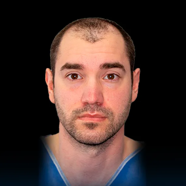 Resultado Transplante Capilar - Antes