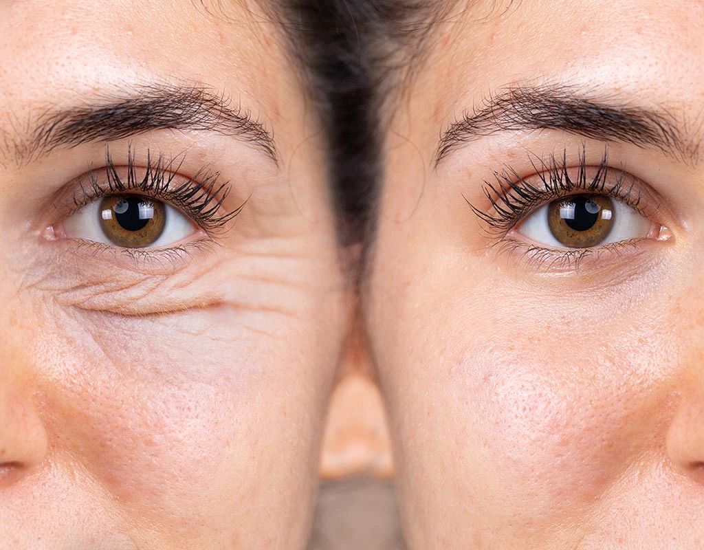Blefaroplastia
