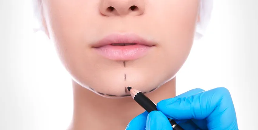 Mentoplastia