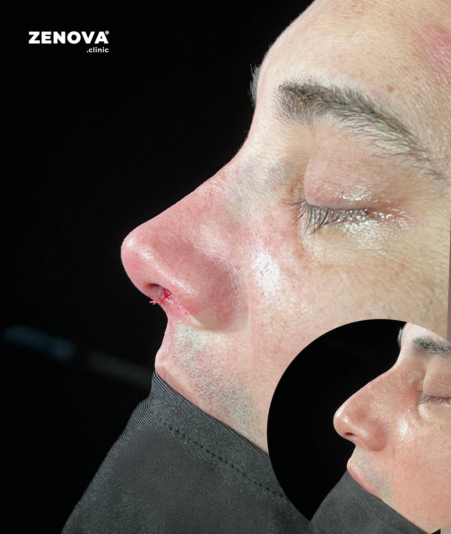 Rinoplastia